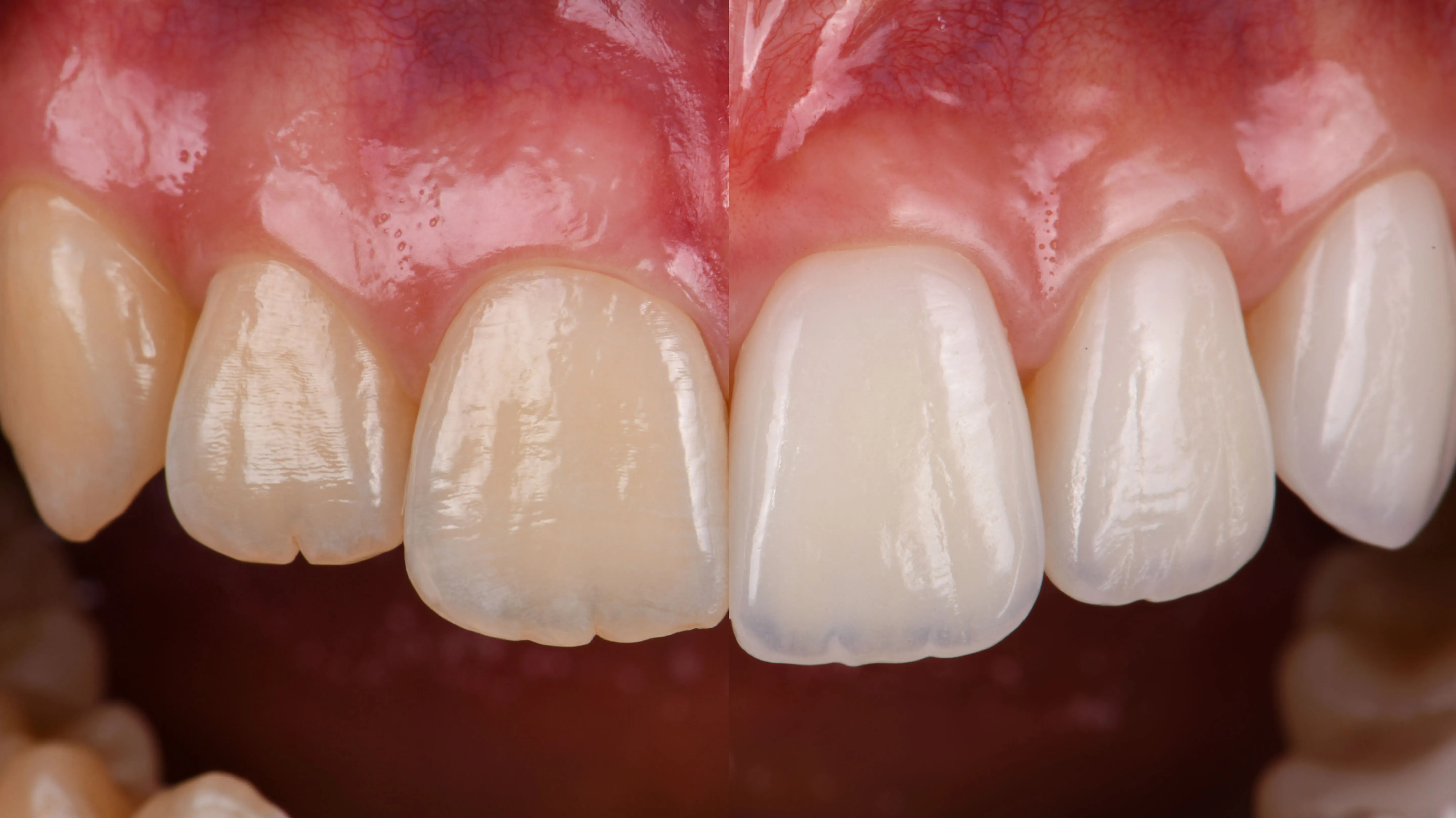 Виниры баннер