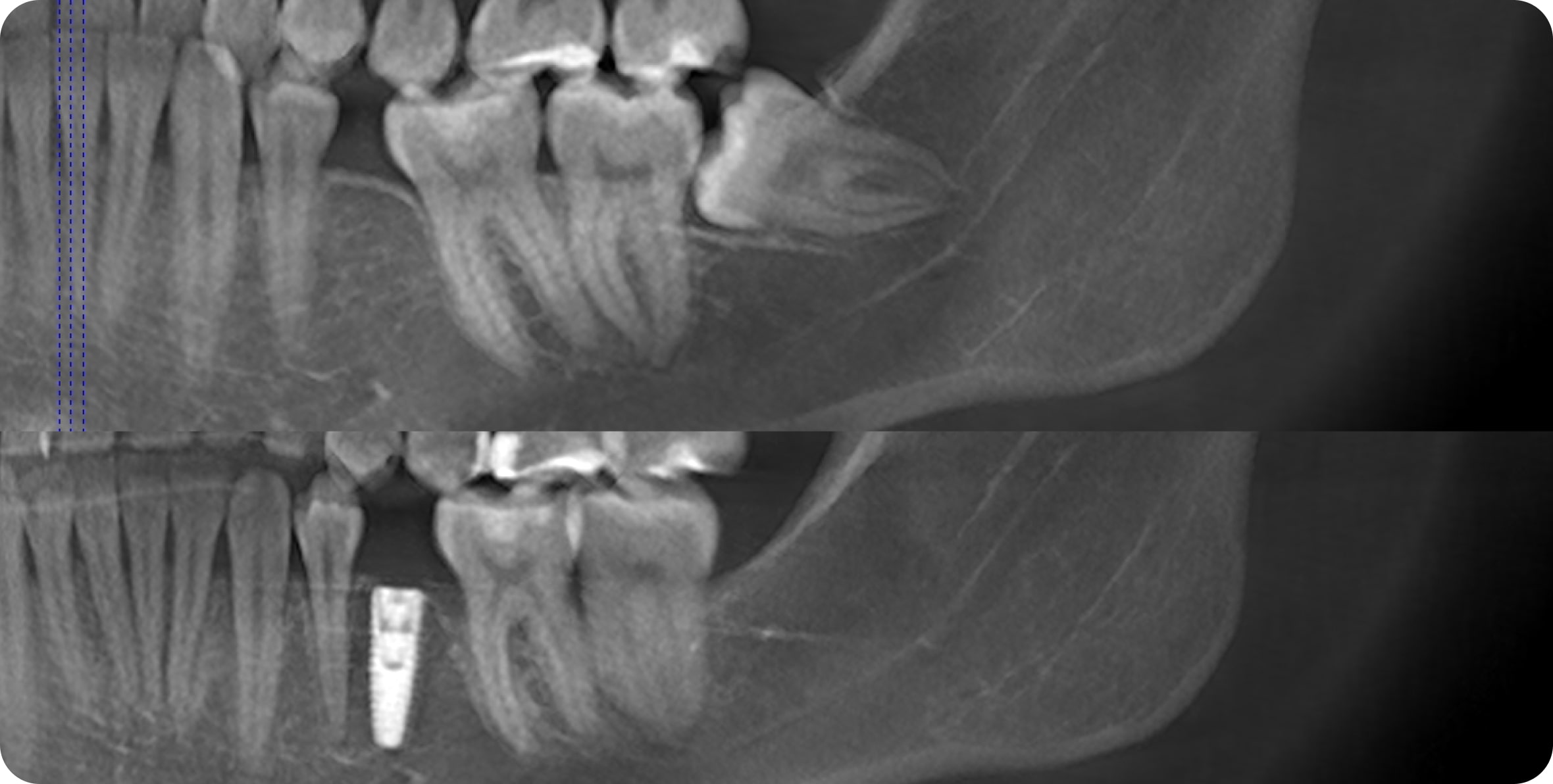 Нужно ли удалять зубы мудрости