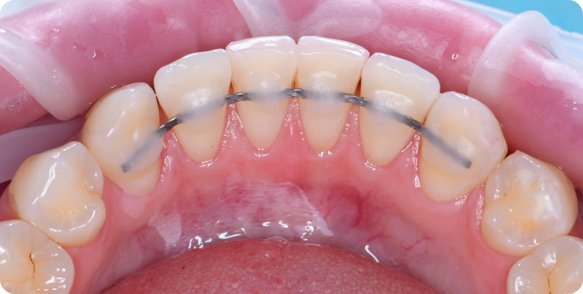 Что за резинки на брекетах