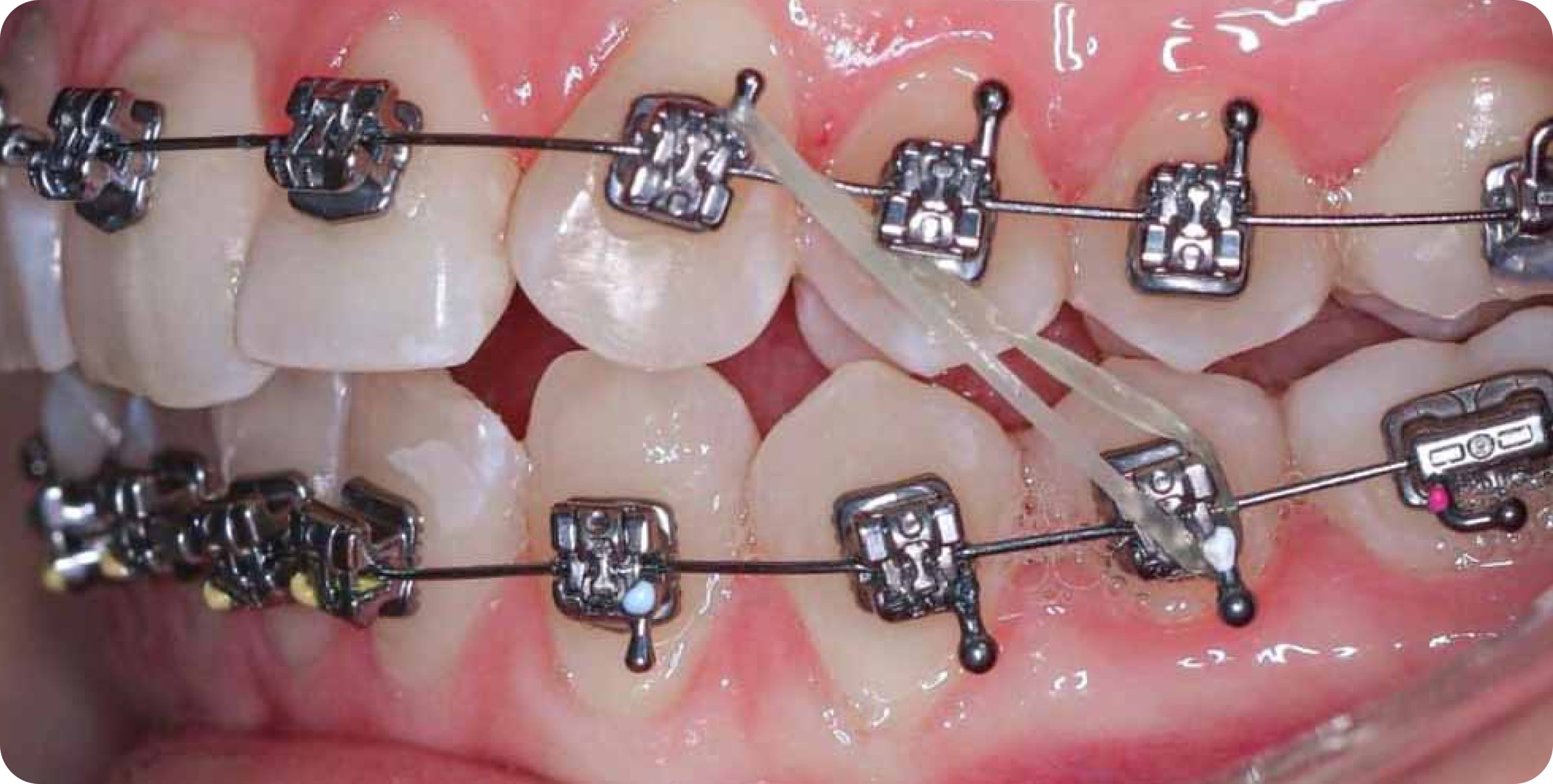 Что такое ретейнер